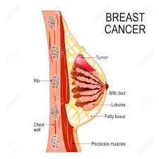 Surviving Breast Cancer
